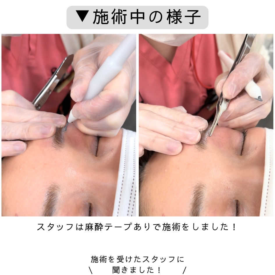 ≪NEW≫ ニードル脱毛（医療針脱毛／絶縁針脱毛）導入【大阪・心斎橋院